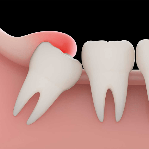 Cách giảm đau khi mọc răng khôn